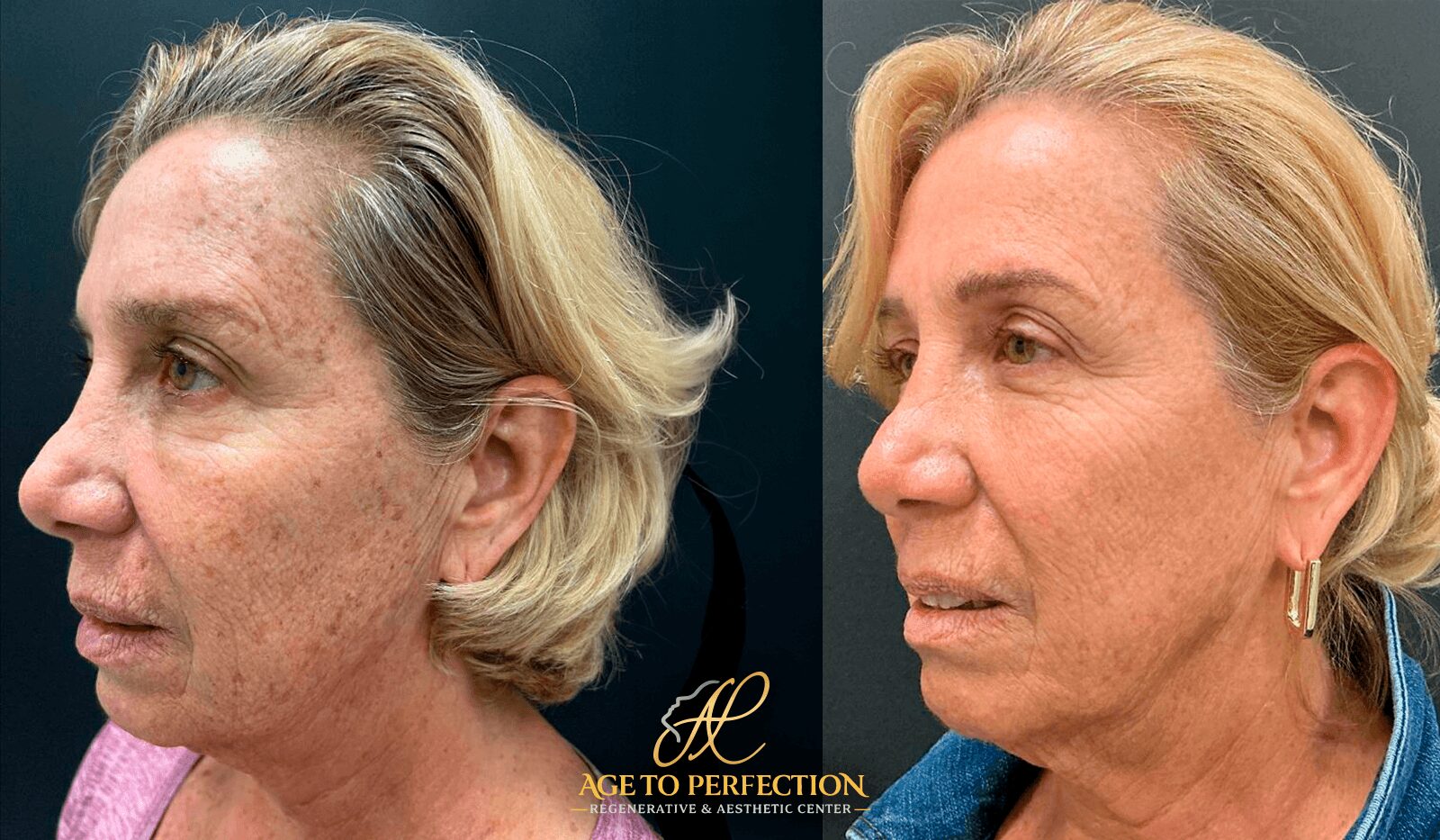 Side-by-side comparison of a woman before and after skincare treatment, showing improved skin texture and reduced age spots.