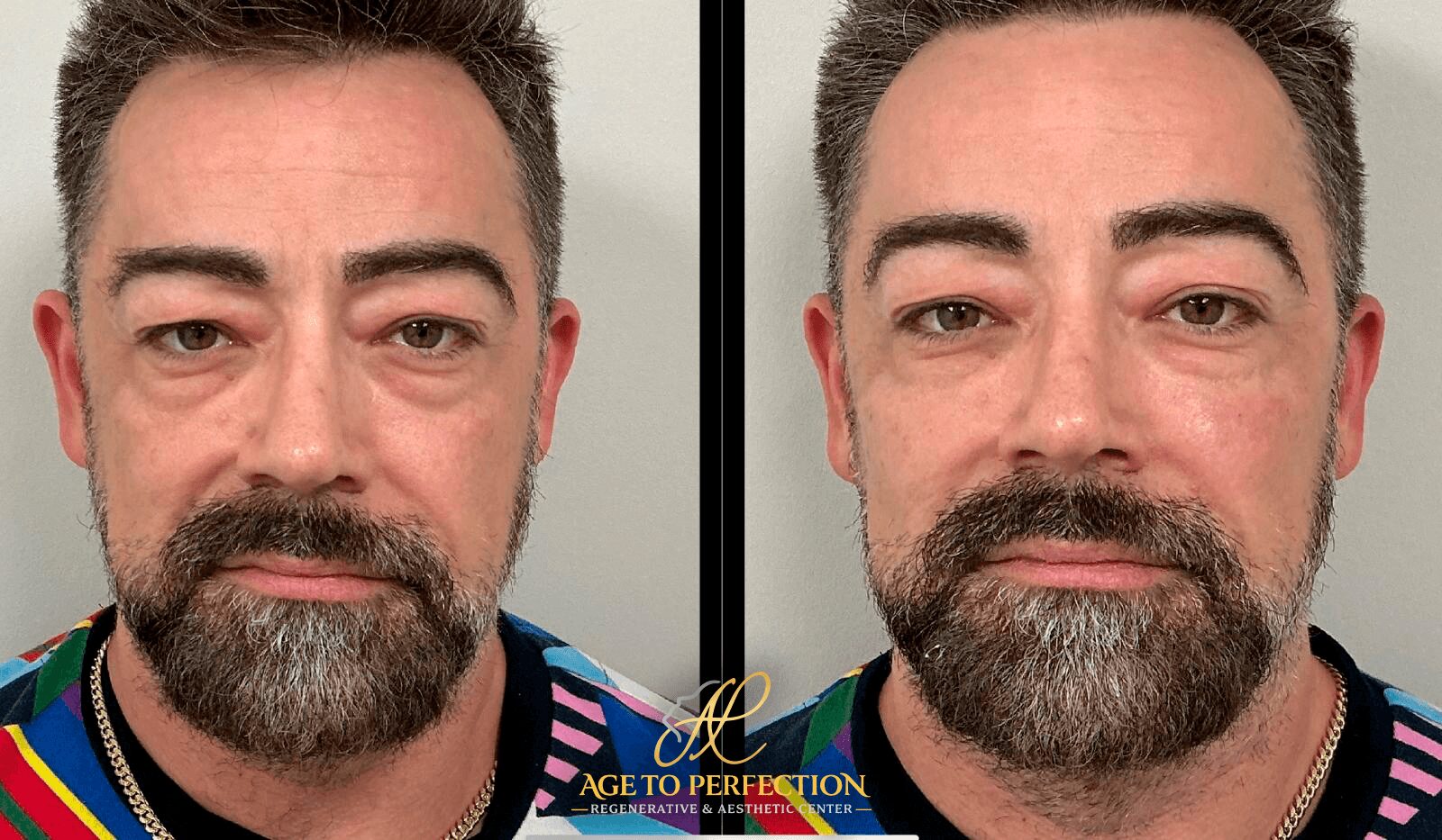 Before and after images of a man with facial improvements, showing reduced puffiness and smoother skin.