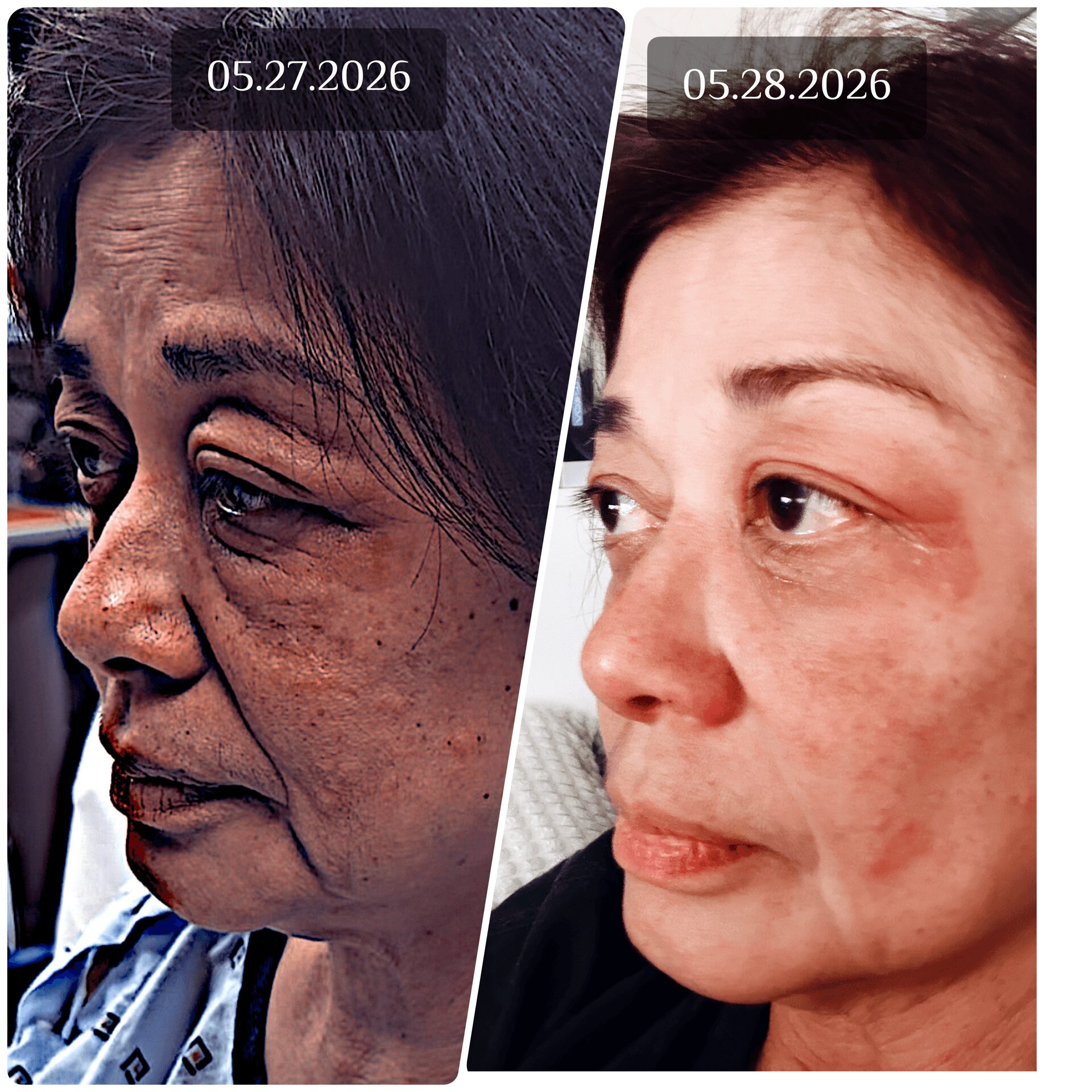 Side-by-side comparison of a woman's face showing skin improvements over a year, with dates 05.27.2026 and 05.28.2026.