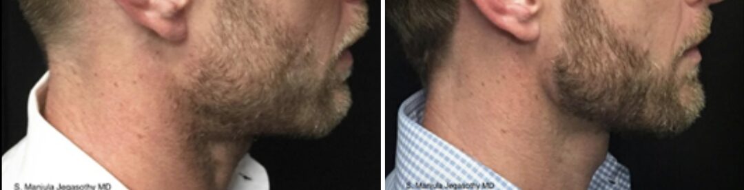 Side view of a man's face and neck before and after a procedure, showing improvement in skin appearance.