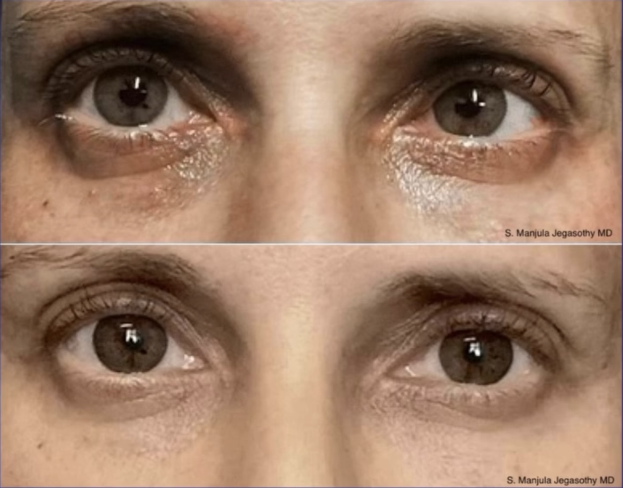 Close-up of eyes showing before and after treatment, with reduced under-eye puffiness and dark circles.