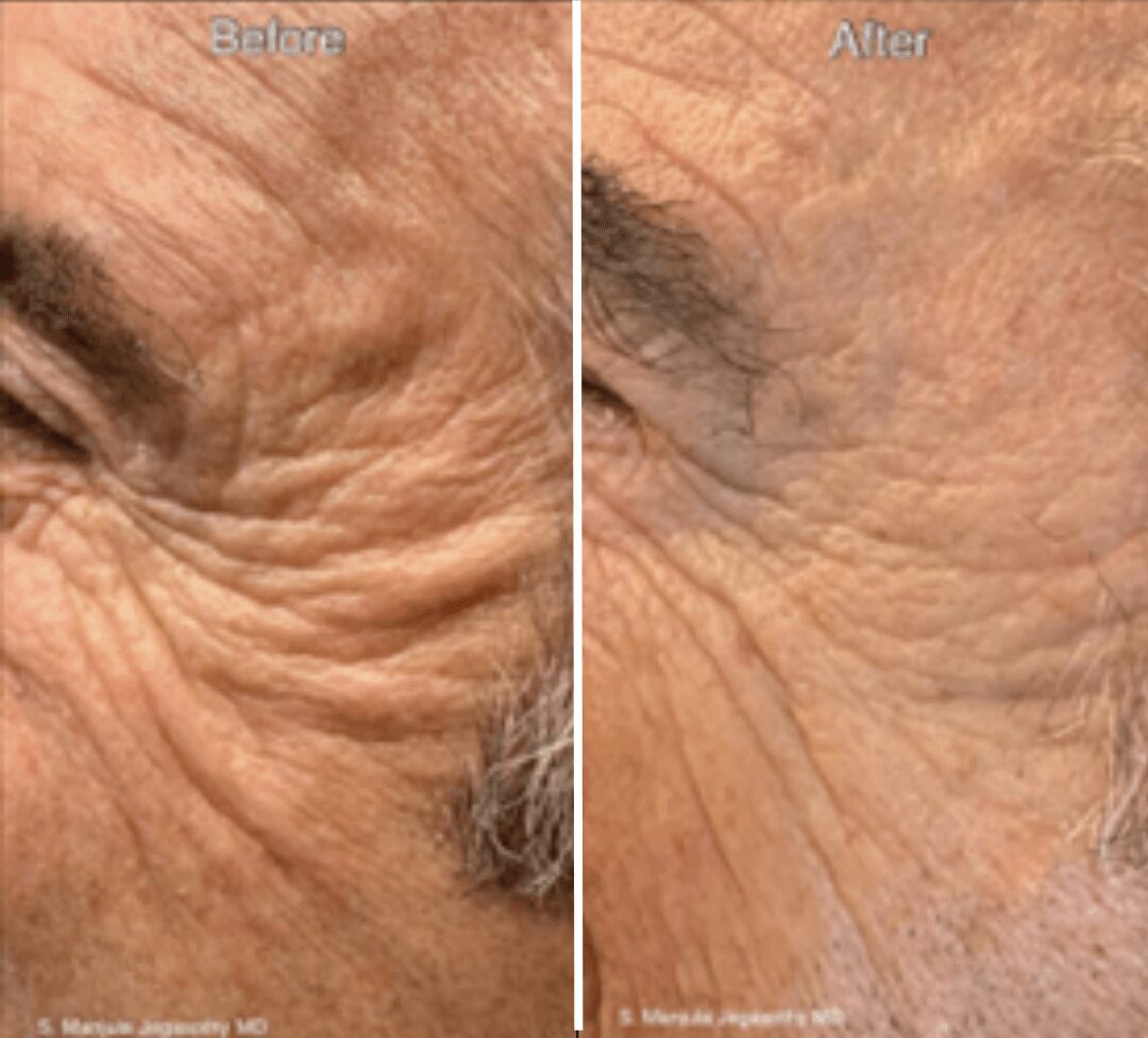 Close-up of skin around eye showing reduction in wrinkles after treatment, with visible skin texture change.