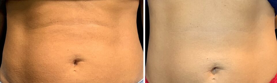 Comparison of abdominal area before and after treatment, showing skin improvement and reduced discoloration.