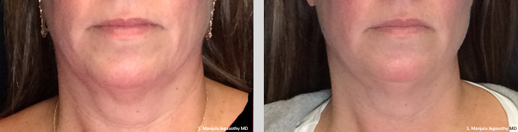 Comparison of neck and lower face before and after treatment, showing improvement in skin appearance.