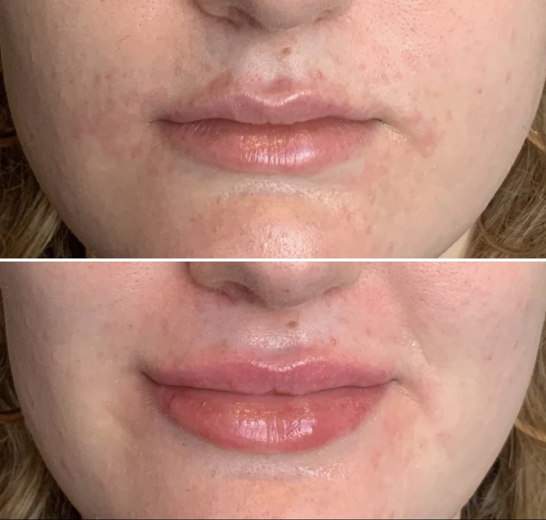 Close-up of lips and lower face before and after lip enhancement, showing fuller, glossier lips in the after image.