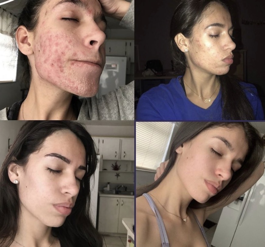 Four women with clear skin, each in different settings, showing side profiles and relaxed expressions.