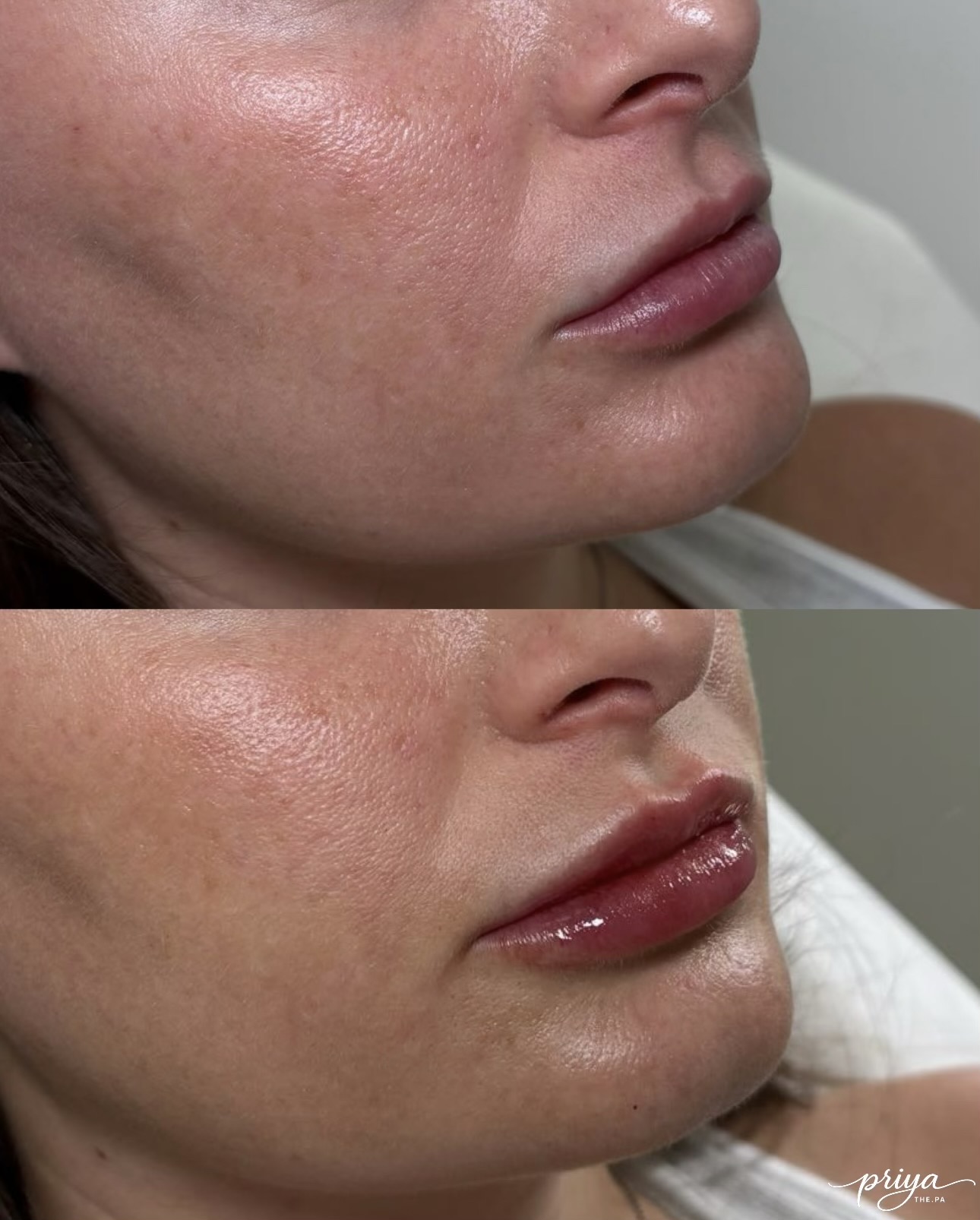 Close-up of a woman's face showing before and after cosmetic lip enhancement, focusing on lips and cheek area.