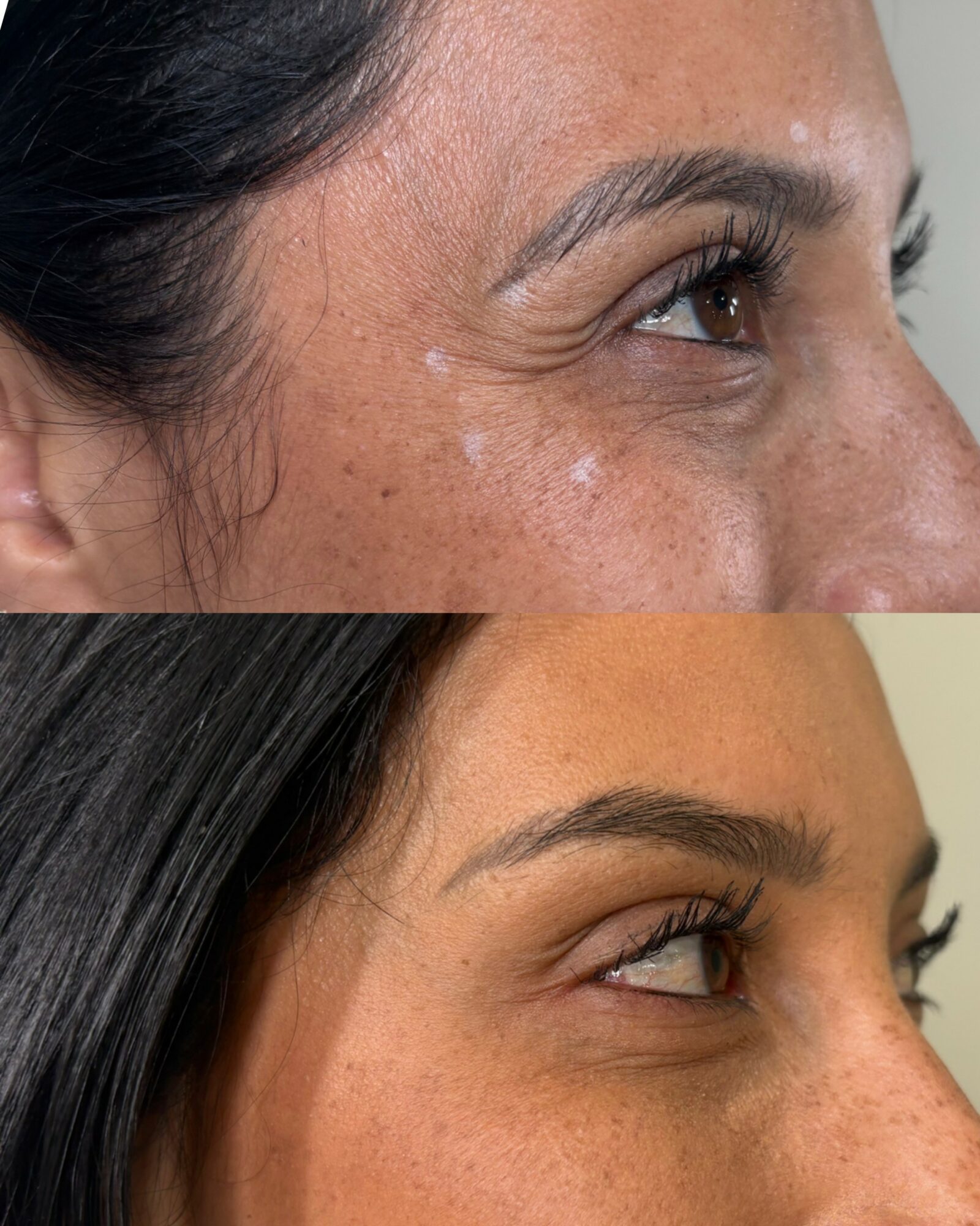Side view of a woman's face showing skin improvement, with visible freckles and smooth skin after treatment.